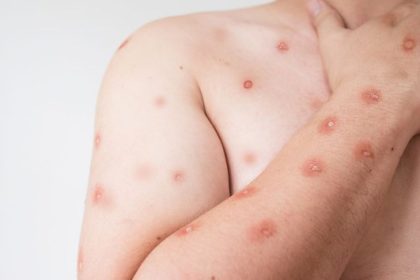 Prefeitura divulga primeira edição de informativo sobre cenário de casos de Mpox em Manaus