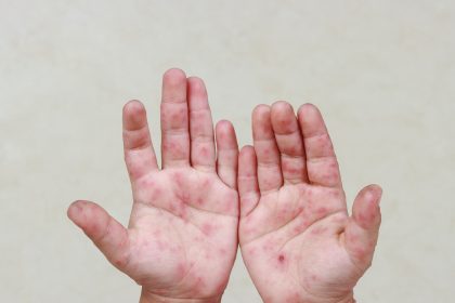 Prefeitura de Manaus pede que população reforce cuidados para prevenir doença mão-pé-boca